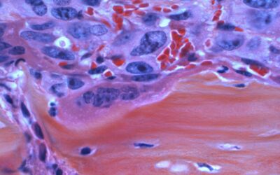 Stratégies efficaces pour la rééducation cognitive post-traitement du cancer de la prostate