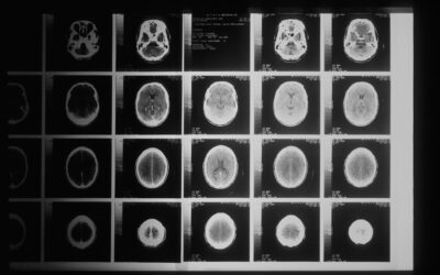 Stratégies efficaces pour la rééducation cognitive post-traitement du cancer de la prostate