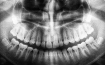 La neuroplasticità e il recupero della memoria dopo un ictus: una speranza concreta